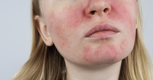 Rosacea treatment Las Vegas
